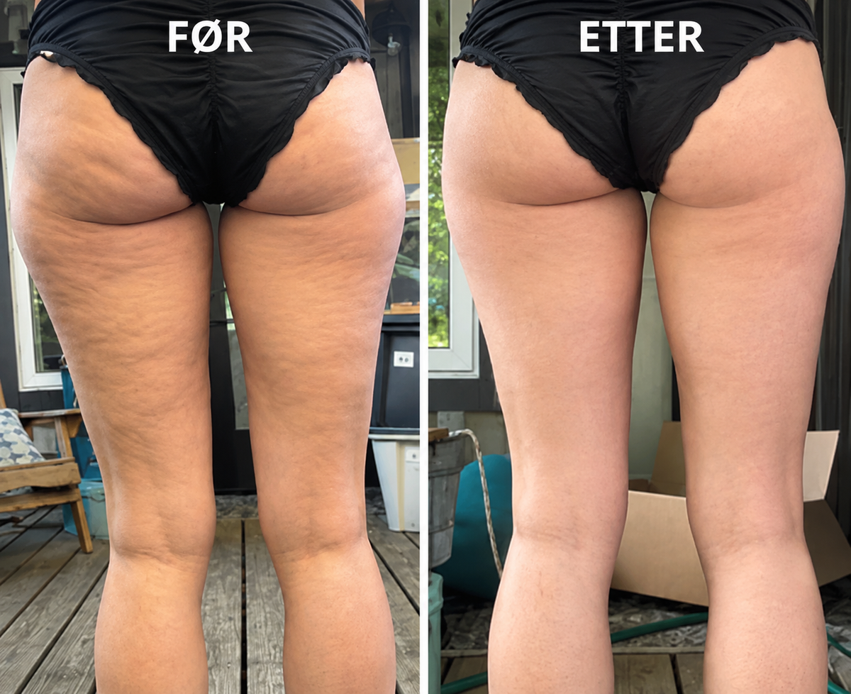 Cellulitemassasje